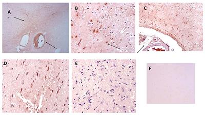 Monomeric C-Reactive Protein Localized in the Cerebral Tissue of Damaged Vascular Brain Regions Is Associated With Neuro-Inflammation and Neurodegeneration-An Immunohistochemical Study